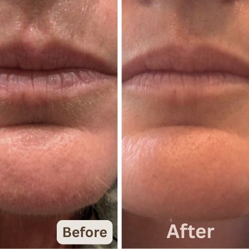 Silca - Finally, End Your Menopausal Mustache!