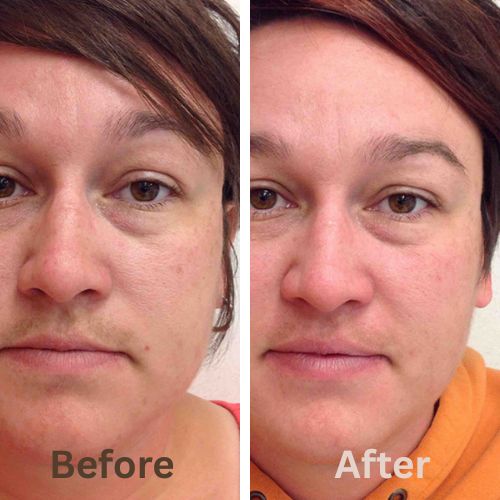 Silca - Finally, End Your Menopausal Mustache!