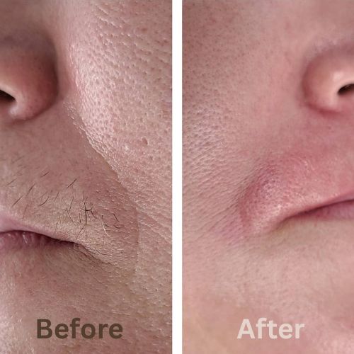 Silca - Finally, End Your Menopausal Mustache!
